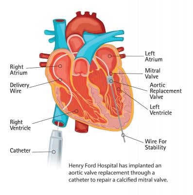 Edwards Lifesciences Sapien Transcatheter Aortic Valve Heart Repair Structural