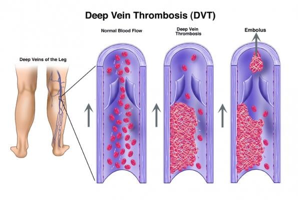 Society of Interventional Radiology SIR Deep Vein Thrombosis DVT PTS Venous