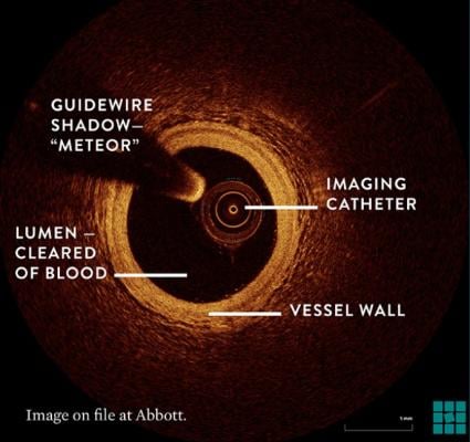 Explanation of optical coherence imaging (OCT) coronary imaging.