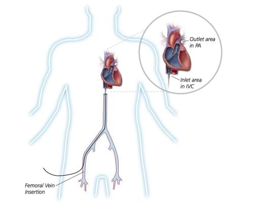 Illustration showing the venous implantation route for the Abiomed Impella RP catheter used for right heart hemodynamic support.
