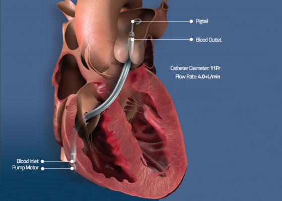 Illustration showing the venous implantation route and where the inlet and outflow ports are when the Abiomed Impella RP is placed in the right side of the heart. The  Impella RP catheter is used for right heart hemodynamic support. 