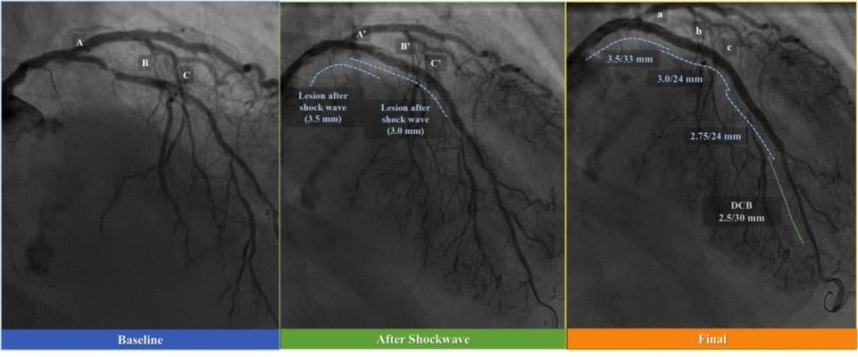 Serial coronary angiograms of the representative case treated with shockwave intravascular lithotripsy.