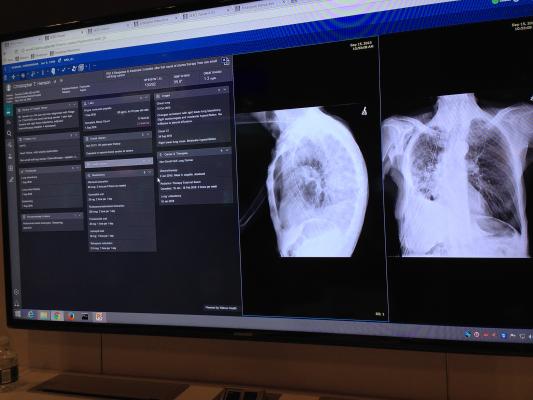 An example of how Agfa is integrating IBM Watson into its radiology workflow. Watson reviewed the X-ray images and the image order and determined the patient had lung cancer and a cardiac history and pulled in the relevant prior exams, sections of the patient history, cardiology and oncology department information. It also pulled in recent lab values, current drugs being taken. This allows for a more complete view of the patient's condition and may aid in diagnosis or determining the next step in care.  