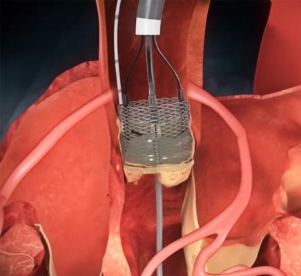heart valve repair hybrid or cath lab reprise II boston scientific lotus tct