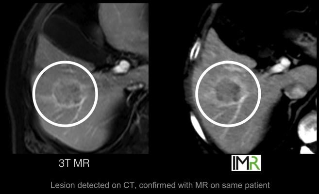 Philips' has developed the IMR CT spectral imaging software, which may offer detailed soft tissue imaging comparable to MRI, as shown here in a comparison of a imaging of the same soft tissue lesion.