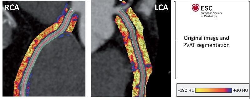 An example of perivascular fat attenuation index (FAI) imaging inside the coronary vascular wall to show areas of inflammation. #SCCT2020