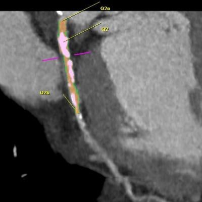 Siemens syngo Circulation Plaque Analysis software is an example of CT plaque characterization software.