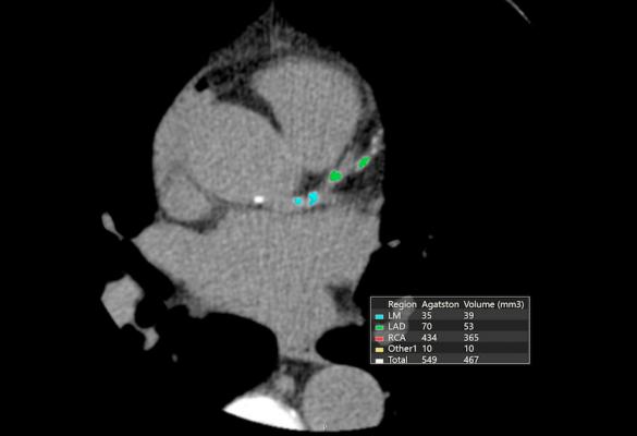 A calcium scoring CT scan (CAC) showing a the calcified lesions in the coronary arteries that are color coded based on which artery segment they are located in. An aggregate assessment of all of calcifications offer a good estimate of a patients risk for a heart attack.