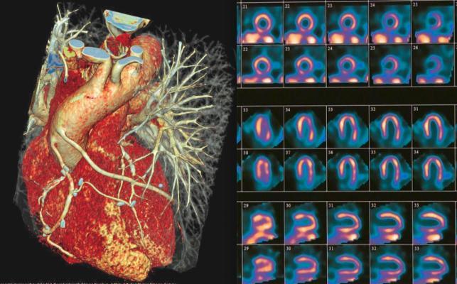 Cardiac CT Given Strong Recommendation as Front-line Imaging of Chest Pain, but the American Society of Nuclear Cardiology (ASNC) did not support the guidelines.  