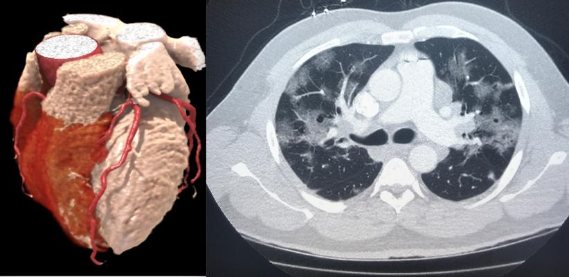 Left, a 3-D rendering of a heart from a cardiac CT exam. Right, a lung-CT exam showing the heart and ground glass lesions in the lungs of a COVID-19 patient. CT has become a front-line imaging modality in the COVID era because it offers both cardiac and lung information to help determine a patients disposition with chest pain, COVID-19 and COVID-caused myocarditis and pulmonary embolism.