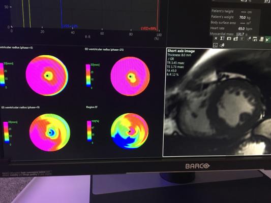 A cardiac MRI perfusion assessment on Fujifilm's analysis software. CMR imaging assessment.