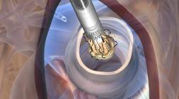 sorin perceval s heart valve repair cardiovascular surgery