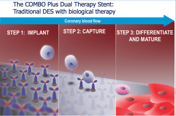 How the OrbusNeich Combo stent works.