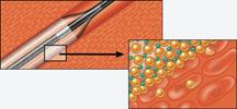 An illustration showing how the Amphirion_drug-eluting, drug-coated balloon technology works.