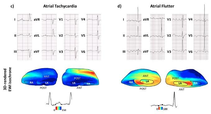 Electromechanical Wave Imaging (EWI) is a new, high-frame rate 3-D rendered ultrasound technique that can noninvasively map the electromechanical activation of heart rhythm. This example shows the ECG tracings compared to the EWI image of the heart.