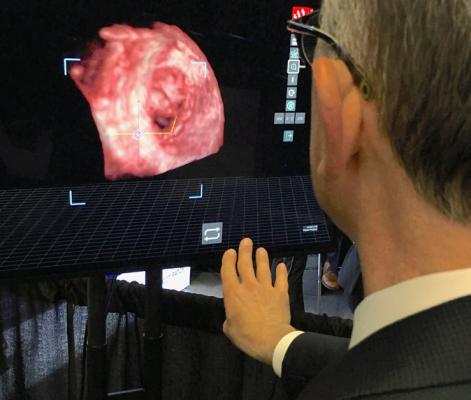 EchoPixel showed technology at TCT 2019 that creates live holograms in the cath lab from 3-D TEE imaging. It projects the holograms on a special display screen that does not require the user to wear 3-D glasses. The interventional cardiologist can use hand movements and a foot switch to move the image around without breaking the sterile field. It offers a new way to visualize catheters, device positioning and deployment for structural heart procedures. #TCT2019 #TCT #TCT19