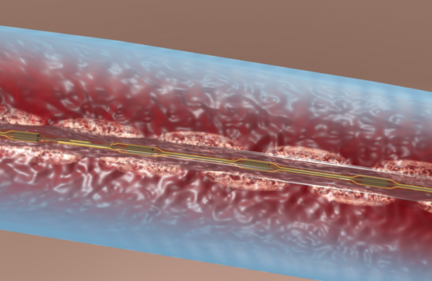 Deep Vein Thrombosis Wikipedia