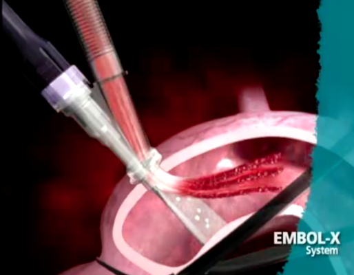Embol-X embolic protection system for surgical valve reaplacement