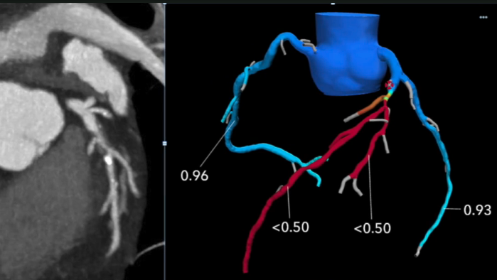 FFR-CT is Ready for Prime-time Evaluation of Coronary Disease | DAIC