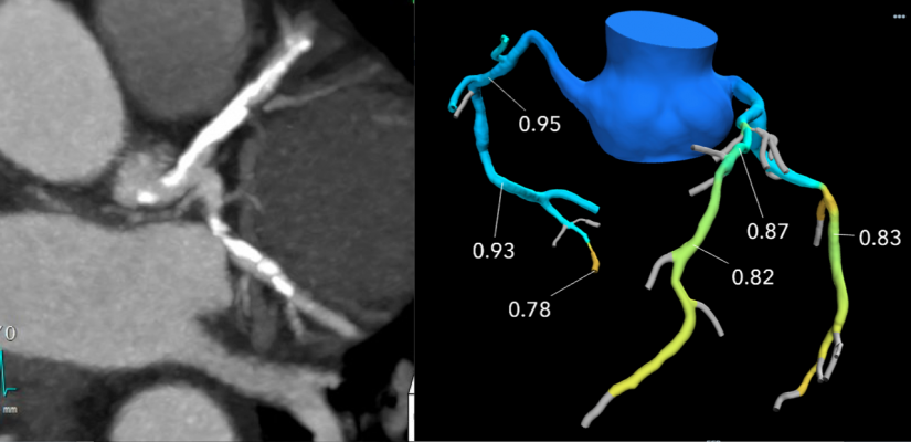 This example of a coronary CT exams on the left shows what looks like severe coronary blockages due to calcified plaques. However, the FFR-CT image of the right  shows the FFR analysis and no stent is needed.  Imaging courtesy of Beaumont Hospital in Royal Oak, Mich.