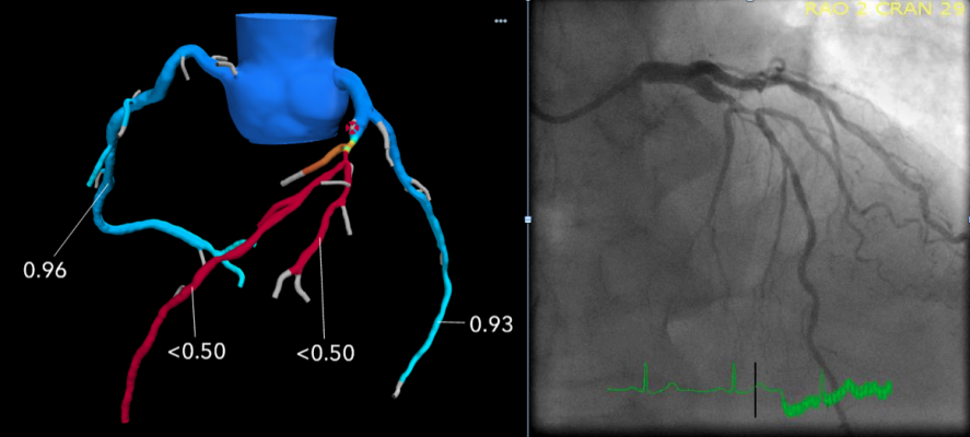 An example of FFR-CT imaging from Beaumont Hospital in Royal Oak, Mich. The left image shows a 3D generated image of the coronary tree from a CT scan evaluated with computational fluid dynamics to determine the FFR numbers. It shows a severe restriction of the left main artery which requires a stent to revacularize. The image on the right is a comparison with the invasive angiogram from the cath lab prior to stenting. 