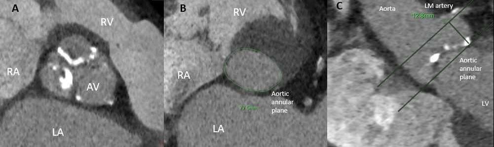 Figure 1: A computed tomography angiography (CTA) study performed for transcatheter aortic valve replacement planning.  Interventional imagers created and interpret these images as part of the heart team.