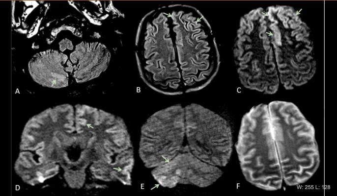This is Figure 2 from the article in Radiology: Acute encephalopathy. A 60 year-old-man without history of seizures presenting with convulsion. (A-B) Multifocal areas of FLAIR hyperintensity in the right cerebellum (arrows in A), left anterior cingular cortex and superior frontal gyrus (arrows in B). (C-D) Restricted diffusion in the left anterior cingulate cortex, superior frontal and middle temporal gyrus (arrows in D) and right cerebellum (arrows in E), consistent with cerebellar diaschisis. #COVID19