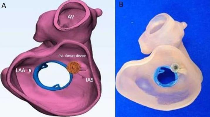 Figure 2: A patient-specific 3-D design (A) and model (B) of a medial paravalvular leak (PVL) in a patient with a surgically implanted mechanical mitral valve. Interventional imagers created and interpret these images as part of the heart team.