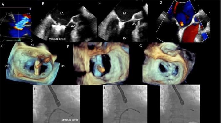 Figure 3: MitraClip implantation at A2-P2 in a patient with severe mitral regurgitation (MR). Interventional imagers created and interpret these images as part of the heart team.