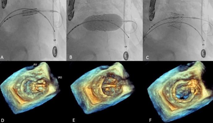 Figure 4: Transcatheter mitral valve-in-valve intervention with a Sapien 3 valve in a patient with a failed bioprosthesis.  Interventional imagers created and interpret these images as part of the heart team.