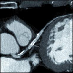 CT Coronary Calcium Scoring Predicts Long-term Cardiac ...