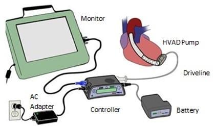 Image of the device showing the internal HVAD pump, which is connected to the external controller by a driveline cable through the skin. The controller is connected externally to the monitor, the AC adapter, and the battery.