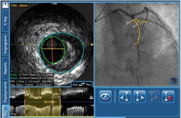 Absorb, imaging bioresorbable stent, IVUS, Volcano, coronary lesion
