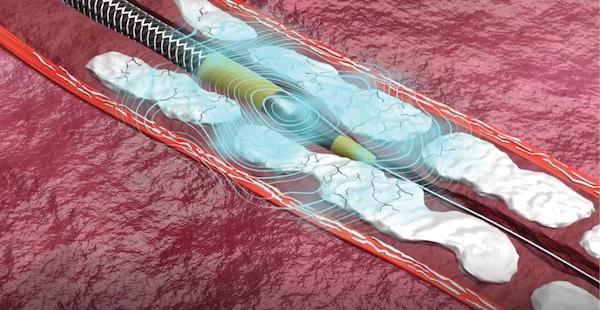 The Next Chapter of IVL