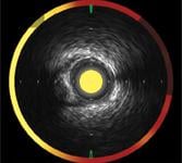 Infraredx IVUS combined with a spectrogram, chemogram