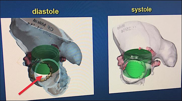 An example of 3-D computer aided design (CAD) software from Materialise being used at Henry Ford Hospital to evaluate left ventricular outflow tract (LVOT) obstruction from a Sapian TAVR valve virtually implanted in the mitral valve position. Henry Ford uses both 3-D printing and CAD to plan and guide complex structural heart procedures. 