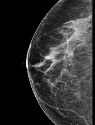 heart disease, breast cancer, HDL