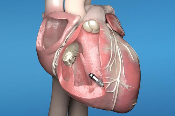 The FDA said the Medtronic Micra leadless pacemaker may have a higher rate of serious complications due to cardiac perforations during implant and is trying to get more information on these incidents. 