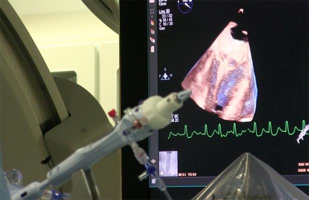 A live 3-D transesophageal echo (TEE) view using a Philips Epiq system after initial deployment of a Mitraclip. The 3-D images are used to help determine the placement of the clip arms and the how well the valve leaflets are engaged. Photo from a MitraClip procedure at the University of Colorado Hospital.