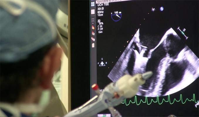 The implantation of a MitraClip is guided under live transesophageal echo (TEE). This image shows the operator moving the open clip into position and engaging the mitral valve leaflets. The clip appears as a arrowhead shape in the ultrasound with the leaflets coming off each side. Photo from a MitraClip procedure at the University of Colorado Hospital. Dr. Dominick Wiktor. The TEE is from a Philips Epiq system.