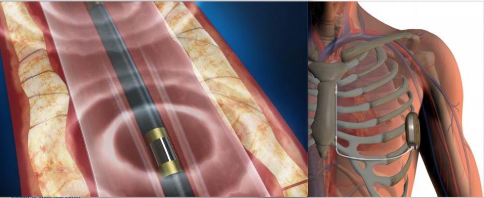 The two biggest cardiac device technology stories in February included the Boston Scientific recall of its S-ICD system, and the FDA clearance of the Shockwave intravascular lithotripsy system to break up calcified lesions in the coronary arteries.