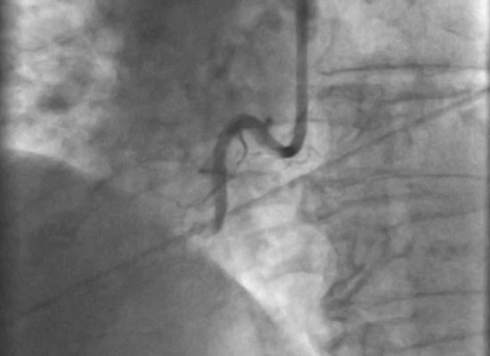 Photo A: This 86-year-old female presented with inferior ST-elevation myocardial infarction. Emergent coronary angiogram (pictured here) showed 100 percent occlusion of right coronary artery with significant thrombus burden, for which aspiration atherectomy was done.