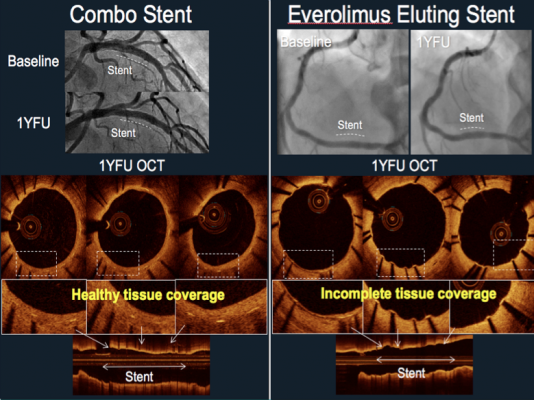 OCT comparison between the Combo vs. Xience stents in the HARMONEE study.
