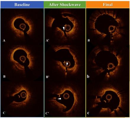 OCT comparison of calcified coronary lesions treated with Shockwave lithoolasty, intravascular lithotripsy.