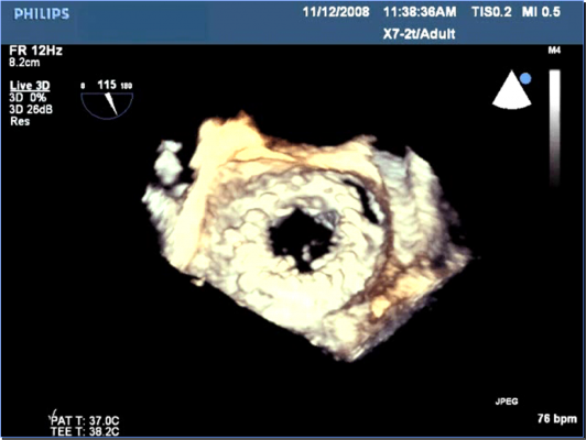 paravalvular leak. This 3-D TEE image shows a paravalvular leak in the 2 o'clock position on the surgical valve implant. Friable cardiac tissue in the elderly and patients with certain conditions can result in sutures pulling out of the tissue, opening gaps around the valve. If the regurgitation of these openings is severe enough, it can cause heart failure or hemolysis. 