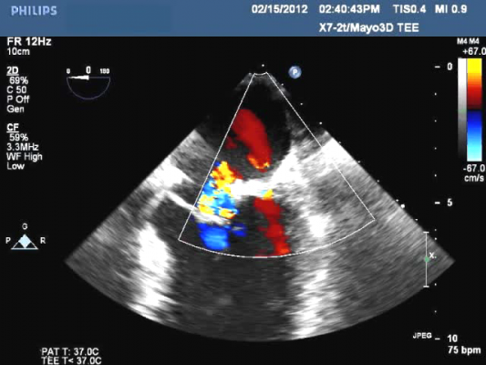 Paravalvular leak seen on cardiac ultrasound.