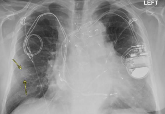 Mri Can Be Safely Performed In Patients With Pacemakers And Icds Daic