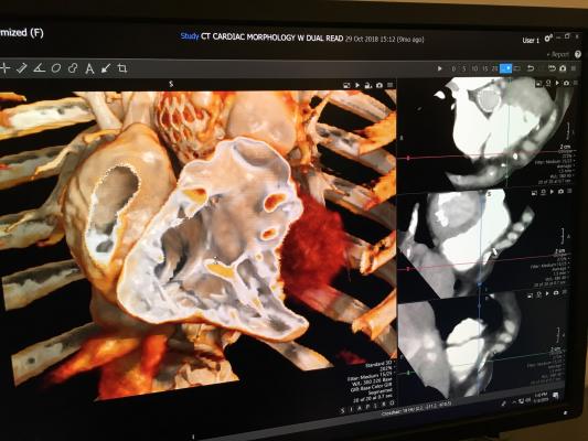 An example of a cardiac computed tomography (CT) exam showing a Medtronic CoreValve transcatheter aortic valve replacement (TAVR) device implanted. The image was reconstructed using Canon Medical’s Global Illumination photo-realistic rendering advanced visualization post-processing software. #SCCT2019