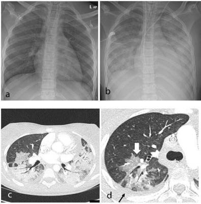 Thoracic findings in a 15-year-old girl with Multisystem Inflammatory Syndrome in Children (MIS-C). (a) Chest radiograph on admission shows mild perihilar bronchial wall cuffing. (b) Chest radiograph on the third day of admission demonstrates extensive airspace opacification with a mid and lower zone predominance. (c, d) Contrast-enhanced axial CT chest of the thorax at day 3 shows areas of ground-glass opacification (GGO) and dense airspace consolidation with air bronchograms. (c) This conformed to a mosai