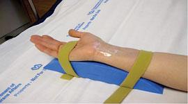 Use of a wrist support for radial access vessel entry prep.
